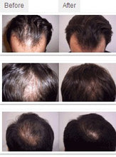 Load image into Gallery viewer, Laser (not LED) helmet 64 /68medical diodes for hair regrowth