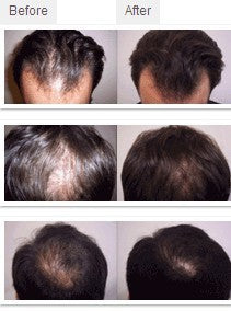 Laser (not LED) helmet 64 /68medical diodes for hair regrowth