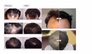 Laser (not LED) helmet 64 /68medical diodes for hair regrowth